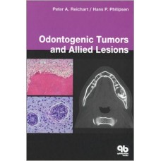 Odontogenic Tumours 1st Edition